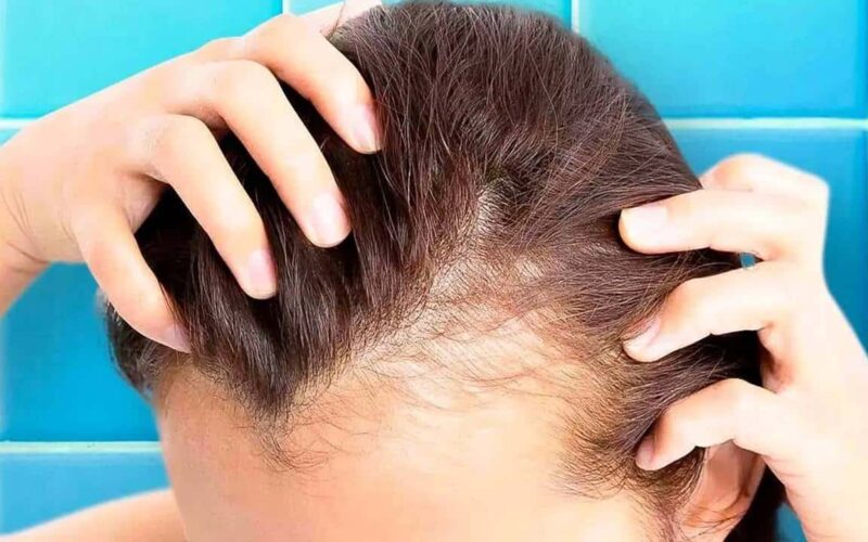 Máscara capilar para estimular o crescimento de cabelo nas áreas mais calvas